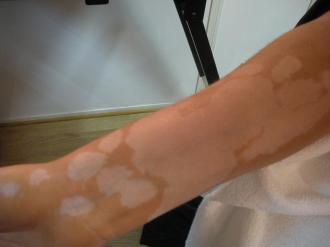 Maquillage Effets Spéciaux vitiligo